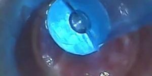 test tube cock endoscope POV urethral insertion ball ro