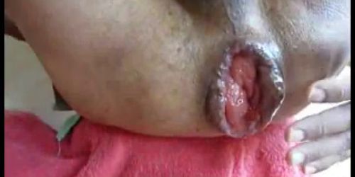 Male extrem asshole - monster anal gape