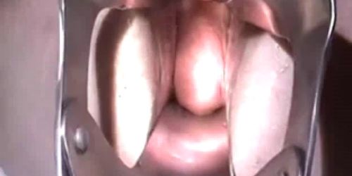 Monster Speculum Anal